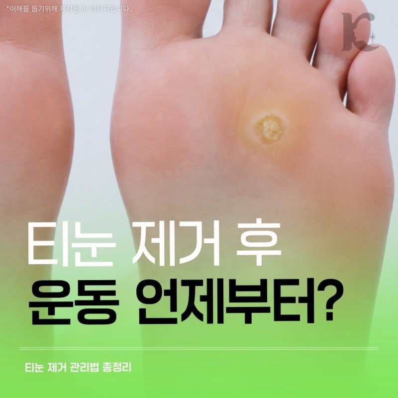 티눈제거후 운동 언제부터? 샤워 물놀이 술이 회복에 미치는 영향