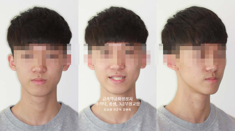 RPE(급속구개확장장치) 를 활용한 교정치료 증례(주걱턱, 3급부정교합, Class3, 총생, 치아 삐뚤....
