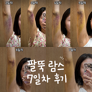 일산 팔뚝 무한 람스 7일차 멍 붓기 변화 통증 접촉성 피부염 흉터 후기