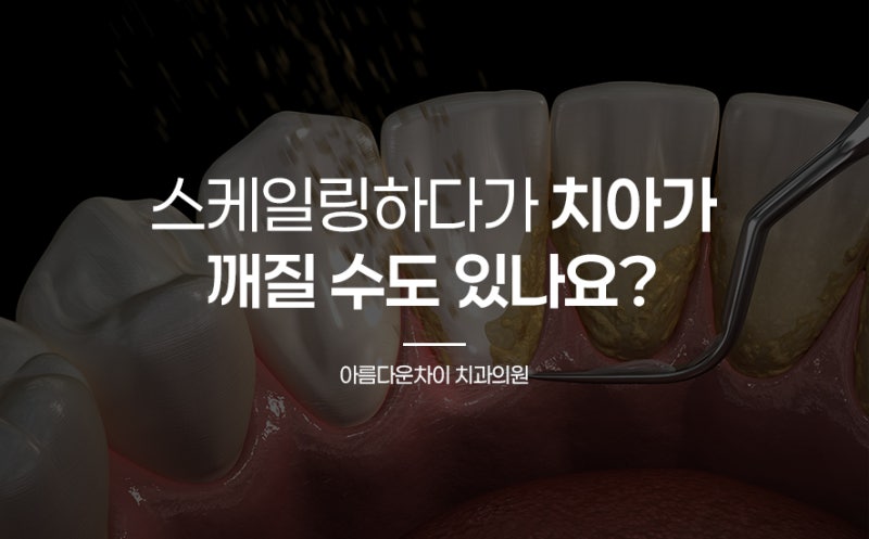 스케일링하다가 치아가 깨질 수도 있나요?