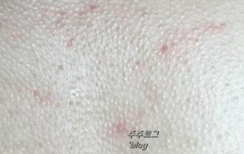 가슴 모공각화증 원인 등, 팔, 다리 닭살피부 여름 자신감 올리는 꿀팁