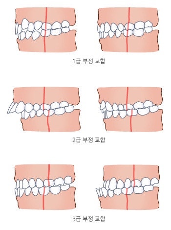 [대구 하악수술 후기 #1 ] 3급 부정교합 | 하악수술을 결심하게 된 계기 & 수술 전 교정 & 수술....