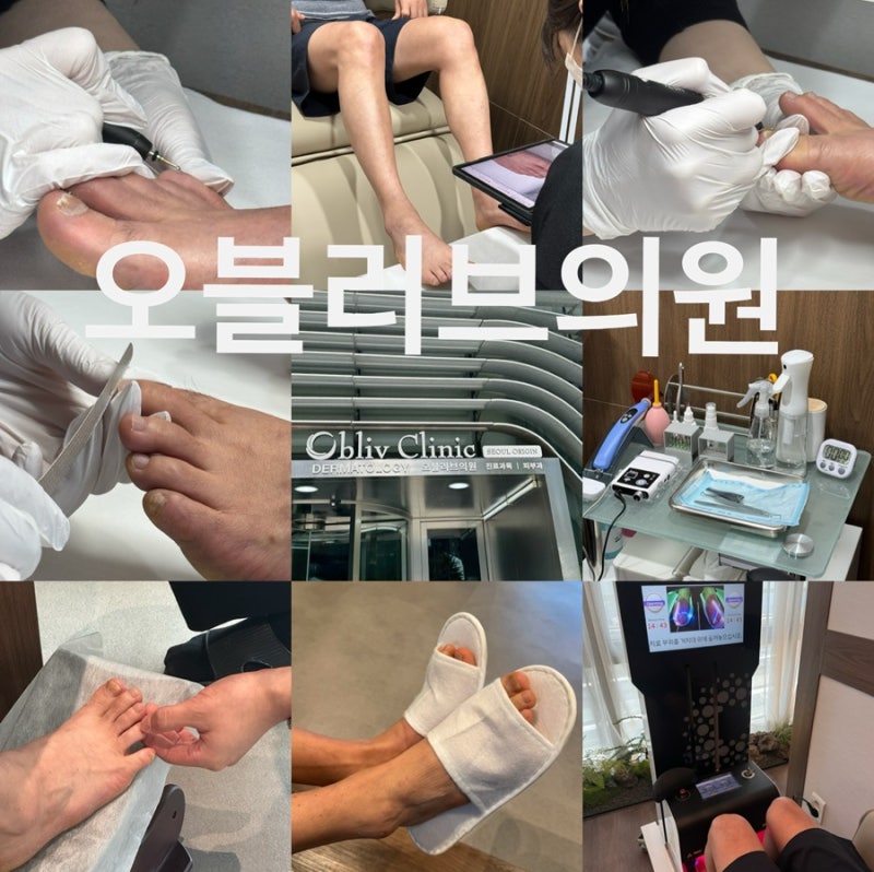 [종로3가피부과] 오블리브의원 서울오리진점, 발톱무좀 치료 1회차 솔직 효과 후기