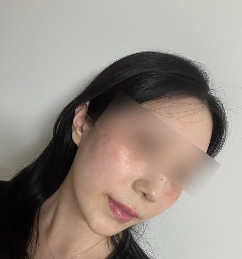 [명동 피부과] 얼굴 전체 점제거, 편평사마귀 비립종 한관종 제거 후기 2탄 내돈내산 후기 개....