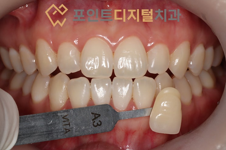 [화성 치아미백] 결혼식 3주 전, 1시간 운전 먼 길 찾아오신 예비 신부님의 치아미백 후기 (A3 → BL4) / 천안 아산
