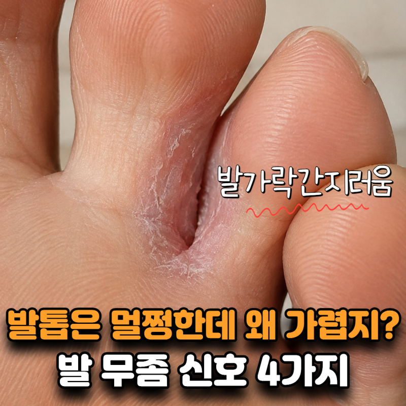 “발톱은 멀쩡한데 왜 가렵지?” 발가락간지러움 무좀 신호 4가지