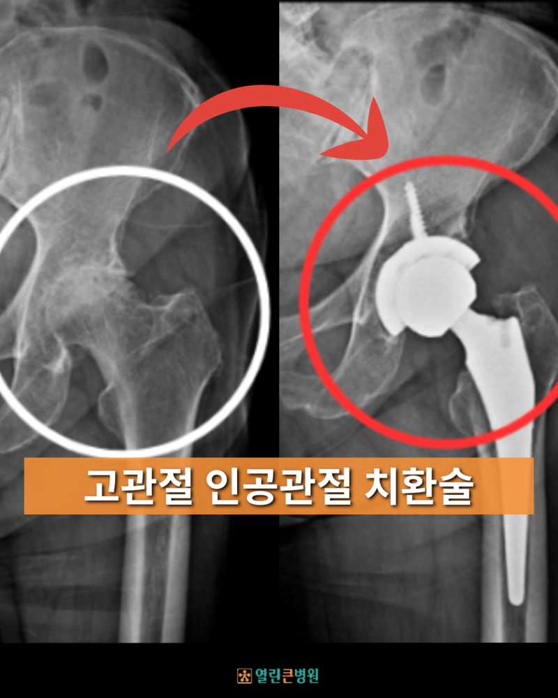 대구 고관절 인공관절 치환술이 뭔가요? 열린큰병원