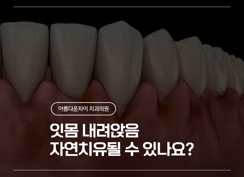 잇몸 내려앉음(치은 퇴축), 자연치유될 수 있나요?