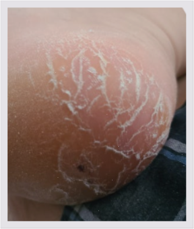 발뿌리는무조무스프레이만 믿고 방치하다 큰일 날 뻔