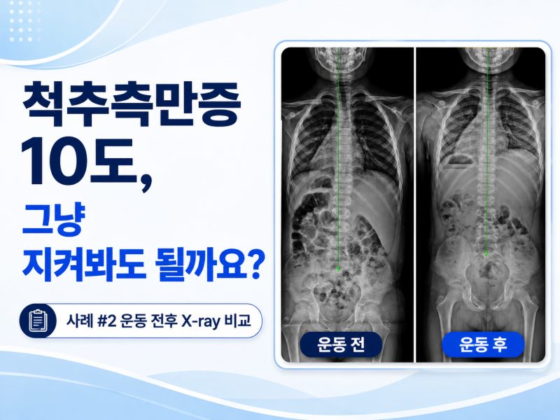 척추측만증 10도, 그냥 지켜봐도 될까요?｜사례 #2 운동 전후 X-ray 비교