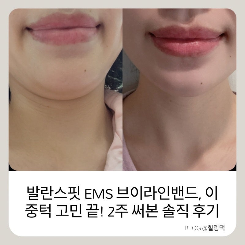 홍현희도 쓴 발란스핏 EMS 브이라인밴드, 이중턱 고민 끝! 직접 써본 솔직 후기