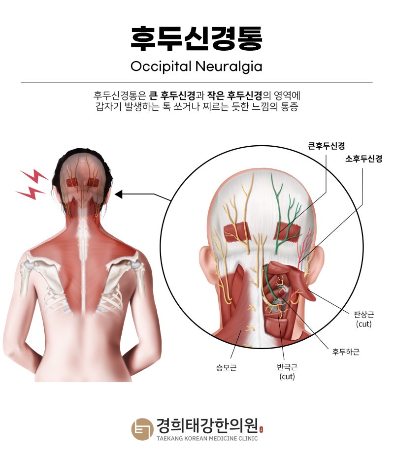 이마·관자놀이·뒤통수가 아픈 이유: 편두통·긴장형두통·경추성두통·후두신경통의 증상 ....