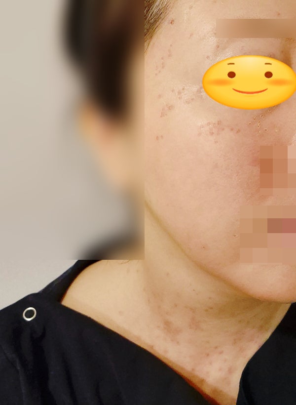 서울 편평사마귀 제거 후기｜얼굴·목 무제한 레이저 가격 +한관종(내돈내산 1탄)