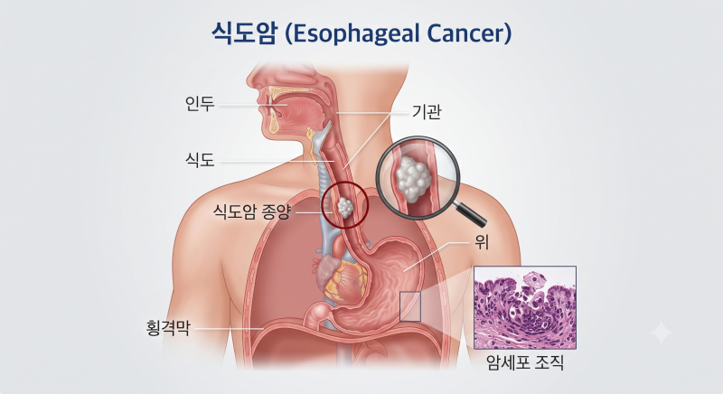 가볍게 생각한 속쓰림이 부른 식도암