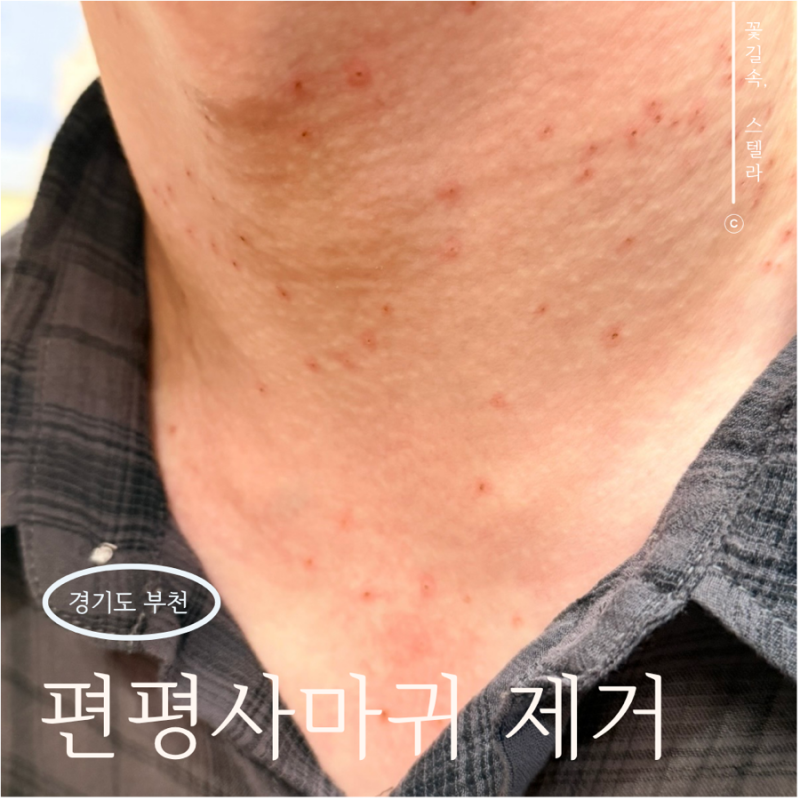 부천 상동역 편평사마귀 제거성지 쥐젖 포함 무제한 제거 후기
