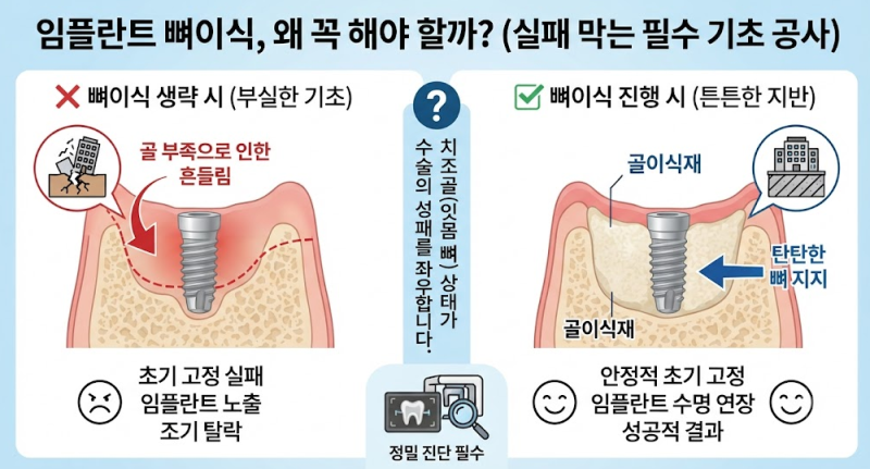 임플란트 뼈이식 왜 꼭 해야 할까? (실패 막는 필수 기초 공사 총정리)