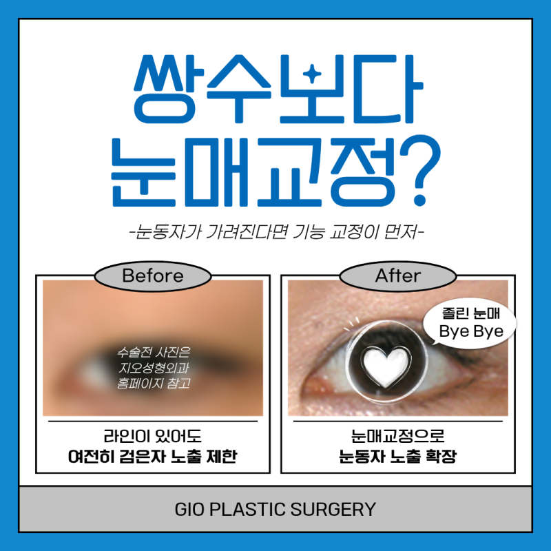안검하수 쌍수 진단일 때 비절개 속쌍 눈매교정 조언