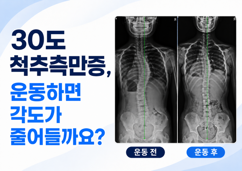30도 척추측만증, 운동하면 각도가 줄어들까요?｜청소년 L Type 사례 #1, Cobb angle 변화