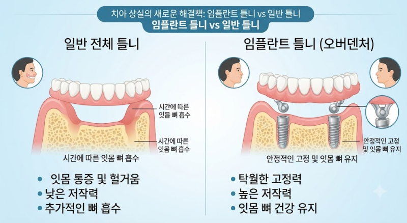 임플란트 틀니(전악 임플란트) 비용·기간·장단점 총정리!