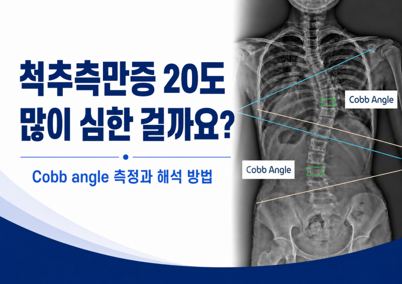 척추측만증 20도, 많이 심한 걸까요?｜Cobb angle 측정과 해석 방법