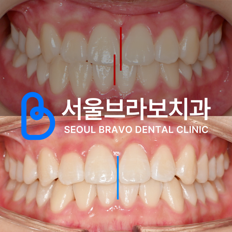 부정교합으로 턱관절 통증이 있다면. 교정으로 개선될 수 있나요?