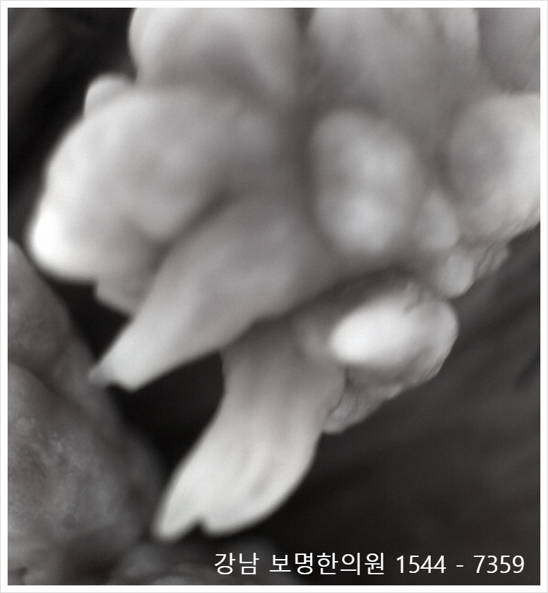 남자 콘딜로마 원인 잠복기 후에 증상이 나타나면?