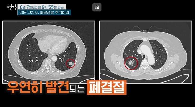 명의 폐결절 여창동 교수 문영규 교수 소화기내과 심장혈관흉부외과 병원 진료 예약 및 프....