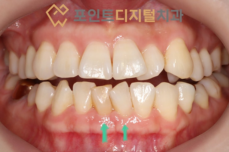[탕정치과] 원인 모르게 어둡게 변색된 앞니(치수괴사), 크라운 없이 자연스럽게 살린 실활치 미백 케이스 / 천안 아산