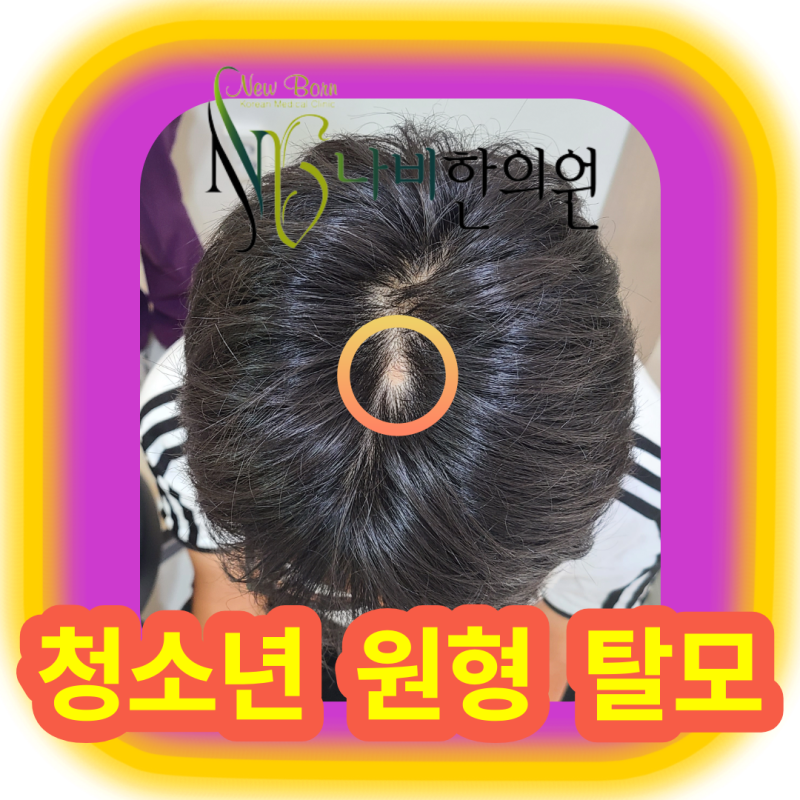부산 청소년 원형탈모, 작아도 병원에 가야 할까요?