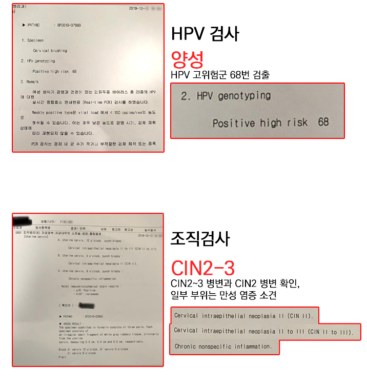 자궁경부이형성증 CIN1, CIN2, CIN3 단계별 필요한 치료 정리