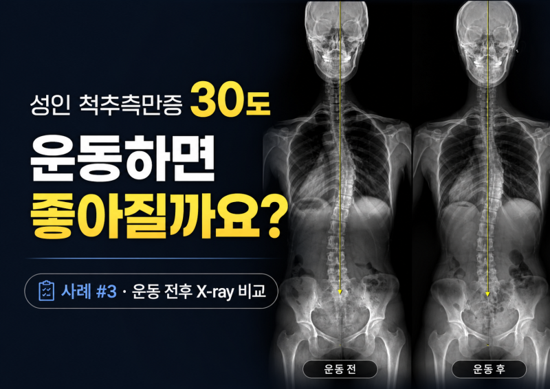 성인 척추측만증 30도, 운동하면 좋아질까요?｜사례 #3 운동 전후 X-ray 비교
