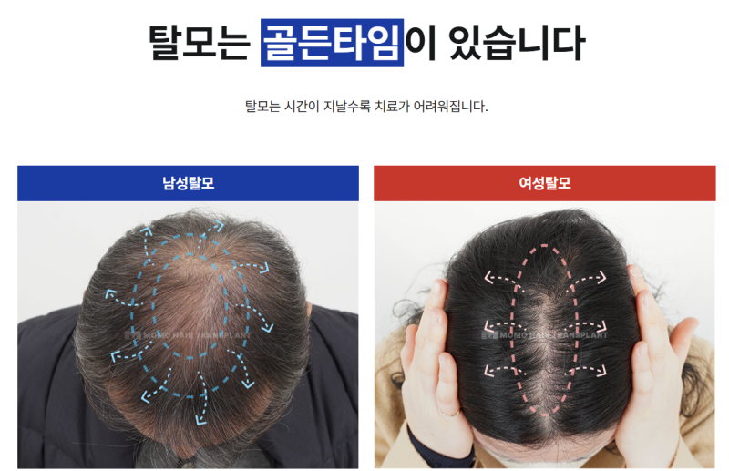 부산 원형탈모 원인, '이것' 모르면 재발이 반복될 수 있습니다