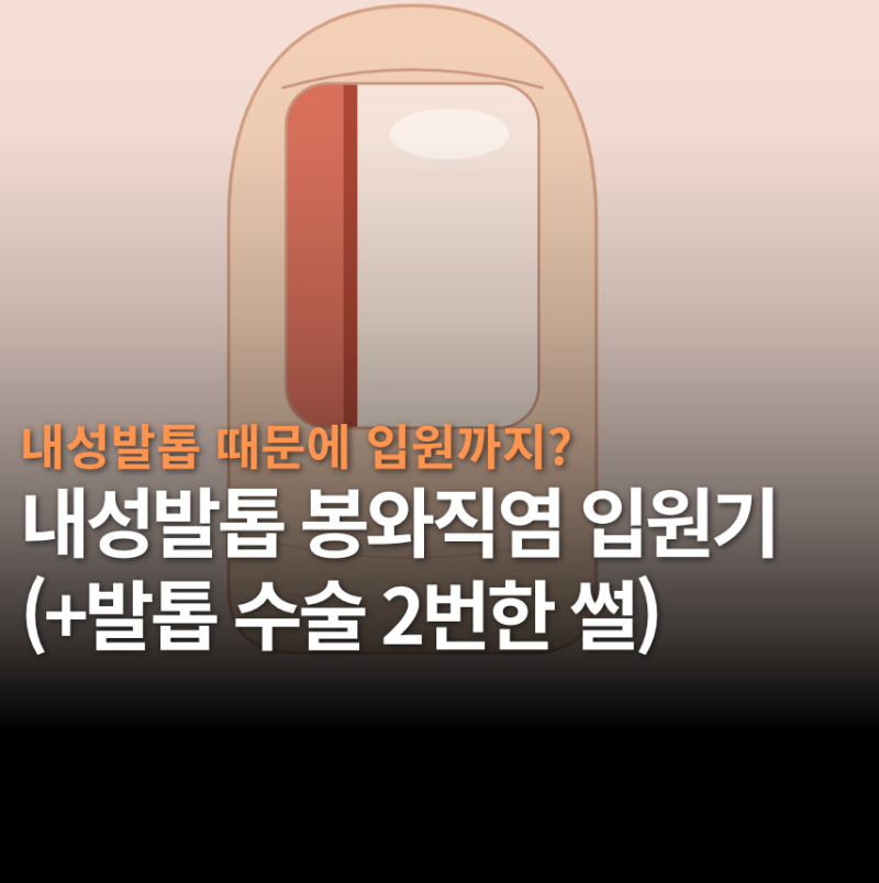 내성발톱 때문에 입원하고 수술 2번한 썰 ㅣ 발등 띵띵 붓고 5일 (+봉와직염, 발톱 뽑기)