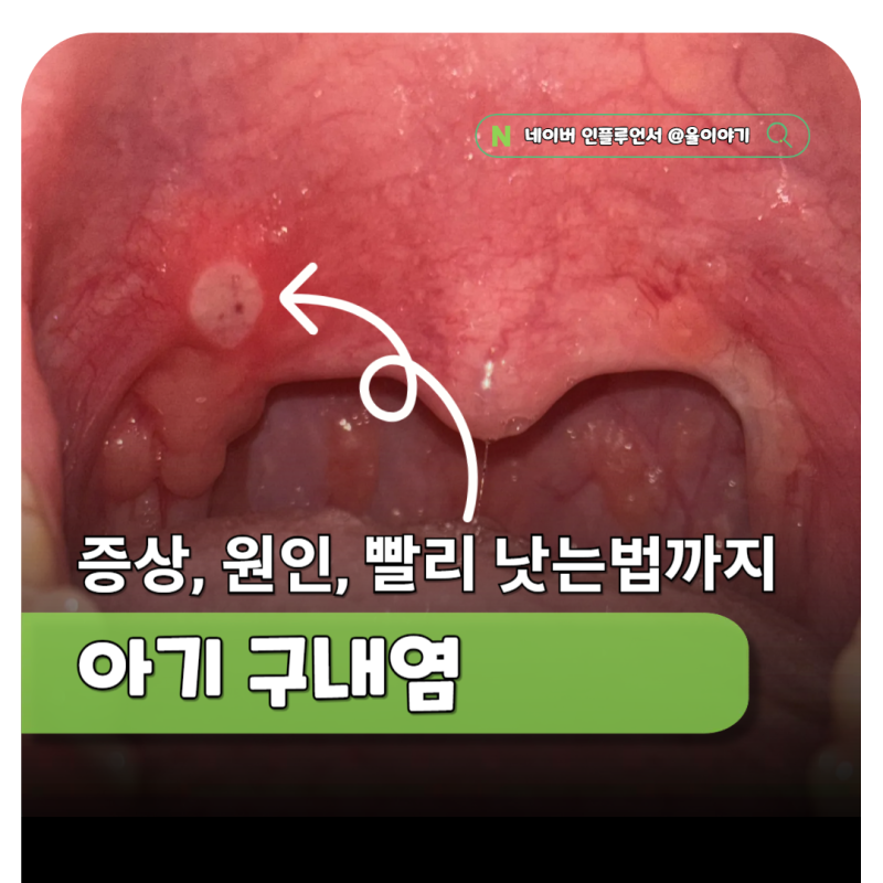 아기 구내염 증상 원인 전염될까? 어린이집 격리기간 며칠?