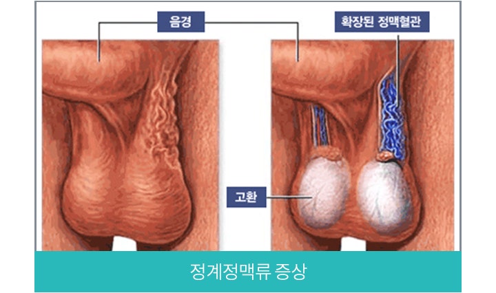 정계정맥류 수술 실비 청구 실손보험 세대별 금액