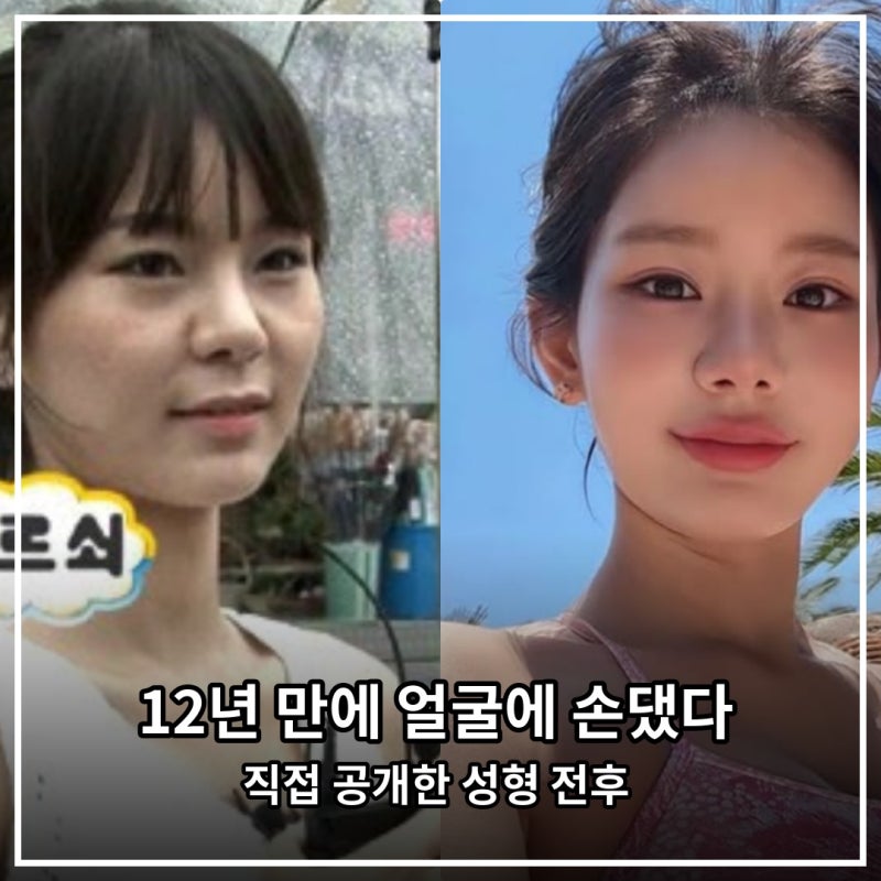 “12년 만에 얼굴에 손댔다…” 맹승지가 직접 공개한 성형 전후