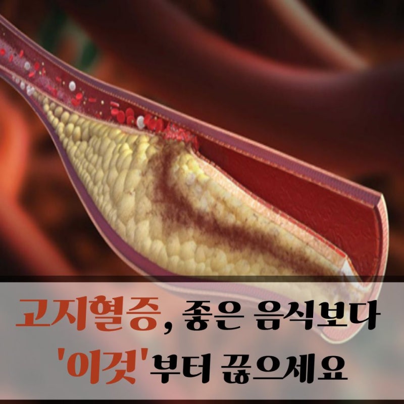 말랐는데 중증 고지혈증 진단 받았어요..고지혈증 좋은 음식 VS 나쁜 음식 차이는 '이것'