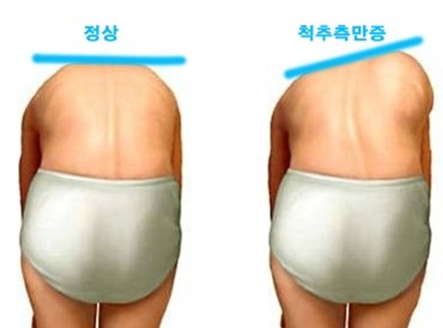 통영 청소년 특발성 척추측만증, 부모님이 꼭 알아야 할 모든 것