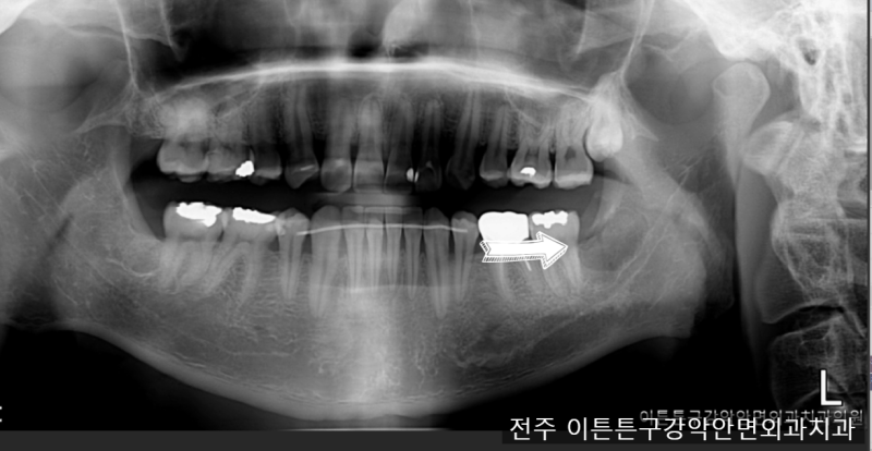 완전매복 사랑니 발치/전주사랑니발치/전주사랑니전문의/전주구강악안면외과/전주구강외과