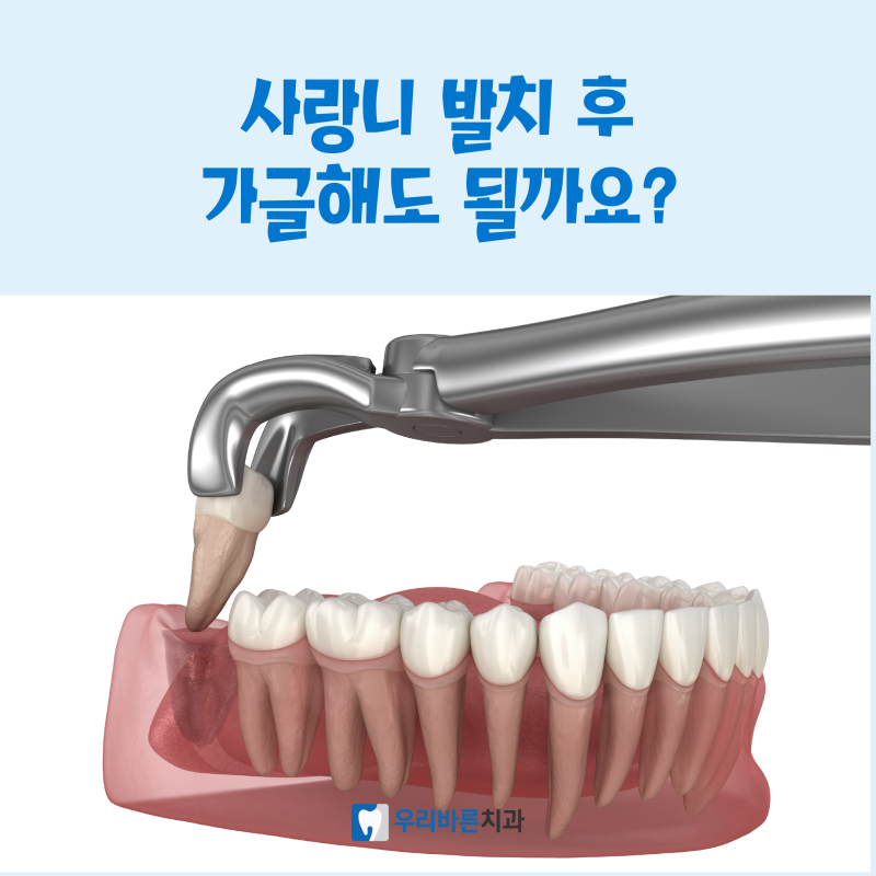 등촌역치과, 사랑니 발치 후 가글 언제부터 해도 될까요?