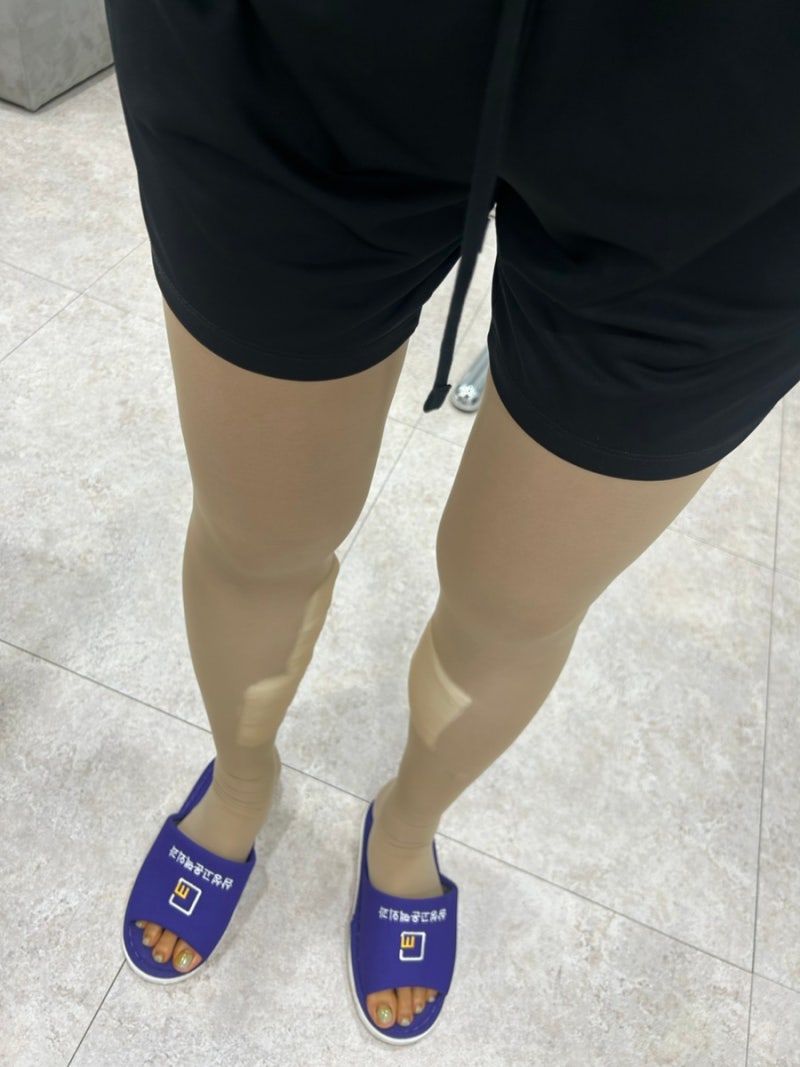 하지정맥류 수술 내돈내산 검사부터 수술까지 자세한 후기
