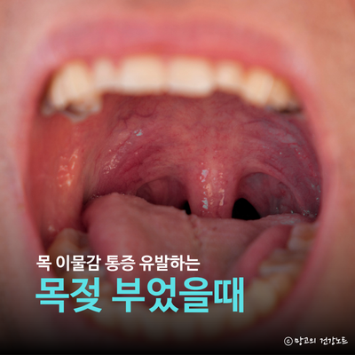 목젖 부음 원인 및 목젖 부었을때 대처법ㅣ병원 기준 편도선염 차이