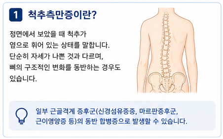 소아 척추측만증, 꼭 치료해야 할까요?