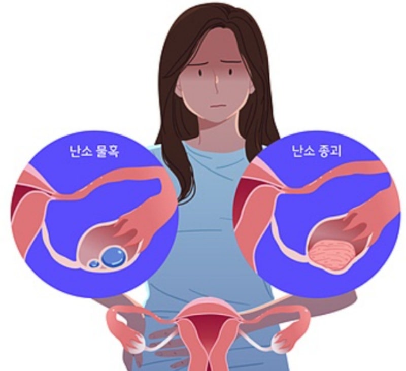 난소 물혹 터짐 괜찮은 걸까? 자연치유일까?