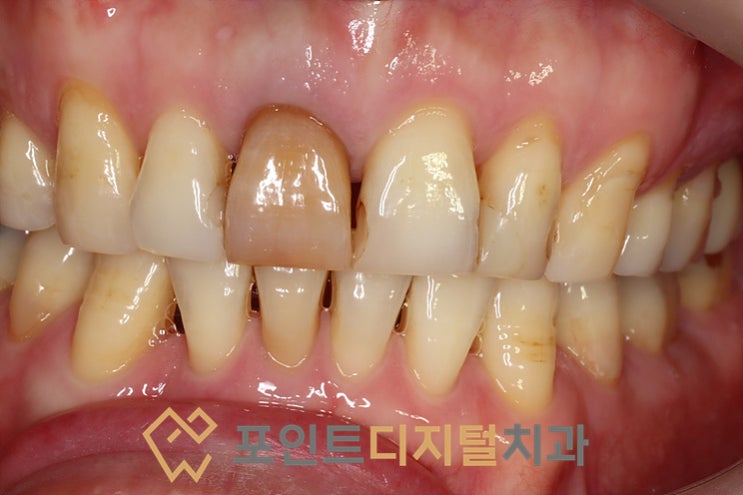 [배방치과] 어둡게 변색된 앞니 치료 : PFZ 크라운과 레진 재치료로 자연스럽게 / 천안 아산
