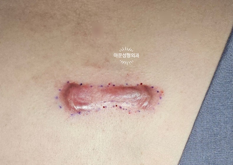 켈로이드 수술, 수술 후 레이저 치료 도움되나요? 가슴 어깨 등 (서울 강동구 아문성형외과)