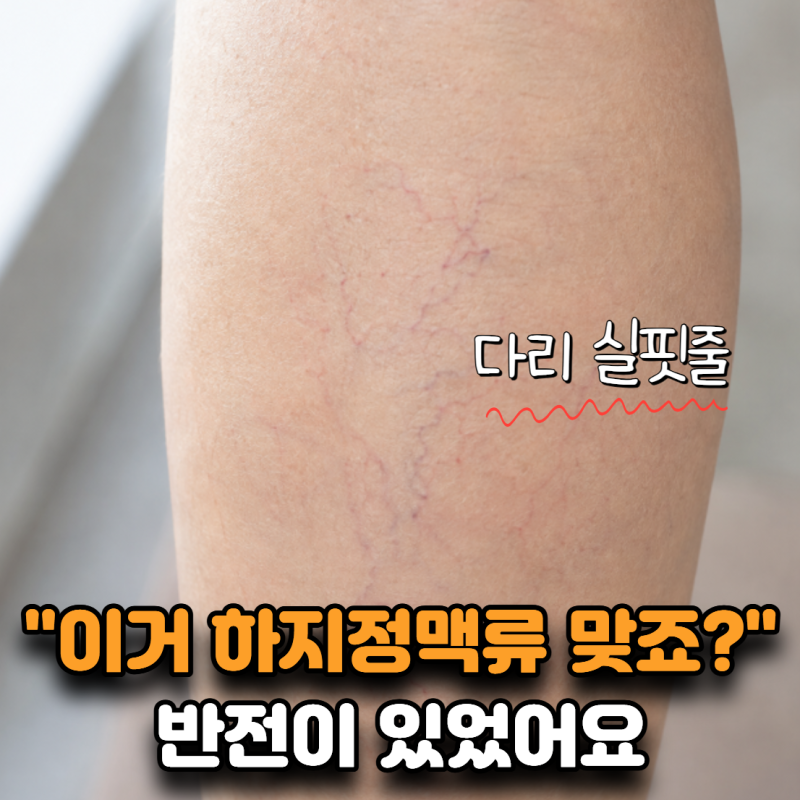 “처음엔 한 줄이었는데 점점 늘었어요” 다리실핏줄 퍼지는 이유