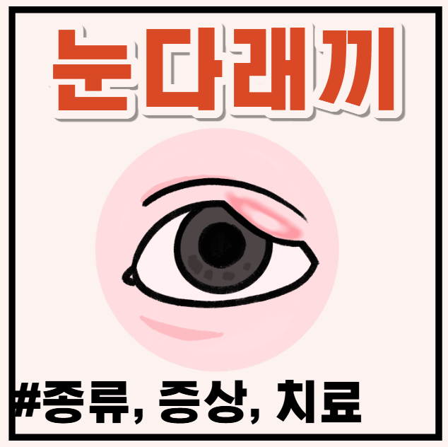 눈에 돋아난 다래끼, 짜도 될까? (겉다래끼·속다래끼 구분법)