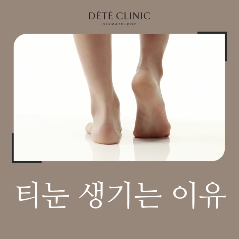 티눈 생기는 이유, 반복되는 발 통증의 원인과 예방법 알아보기