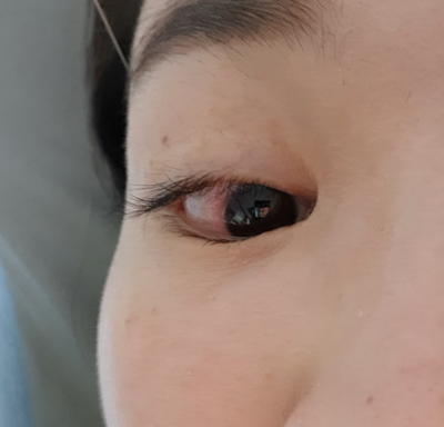 마이봄샘 안구건조증, 인공눈물 대신 30일간 눈꺼풀 청소해 본 후기